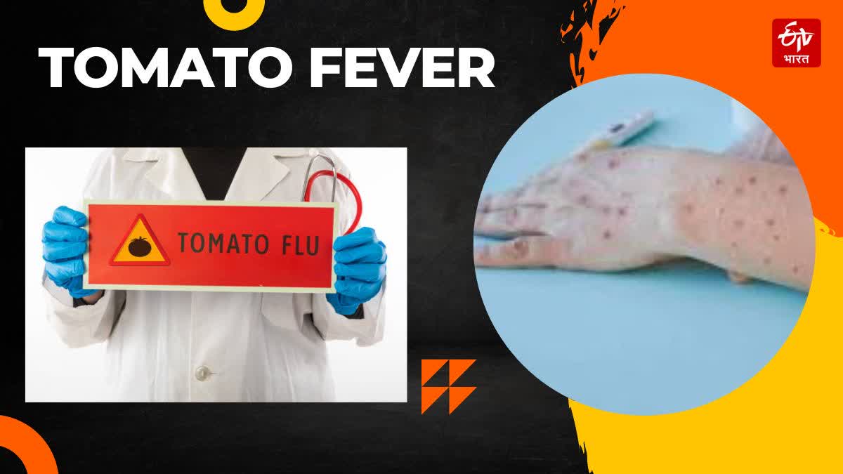 viral fever in Kerala  Tomato Fever dengue and rat fever
