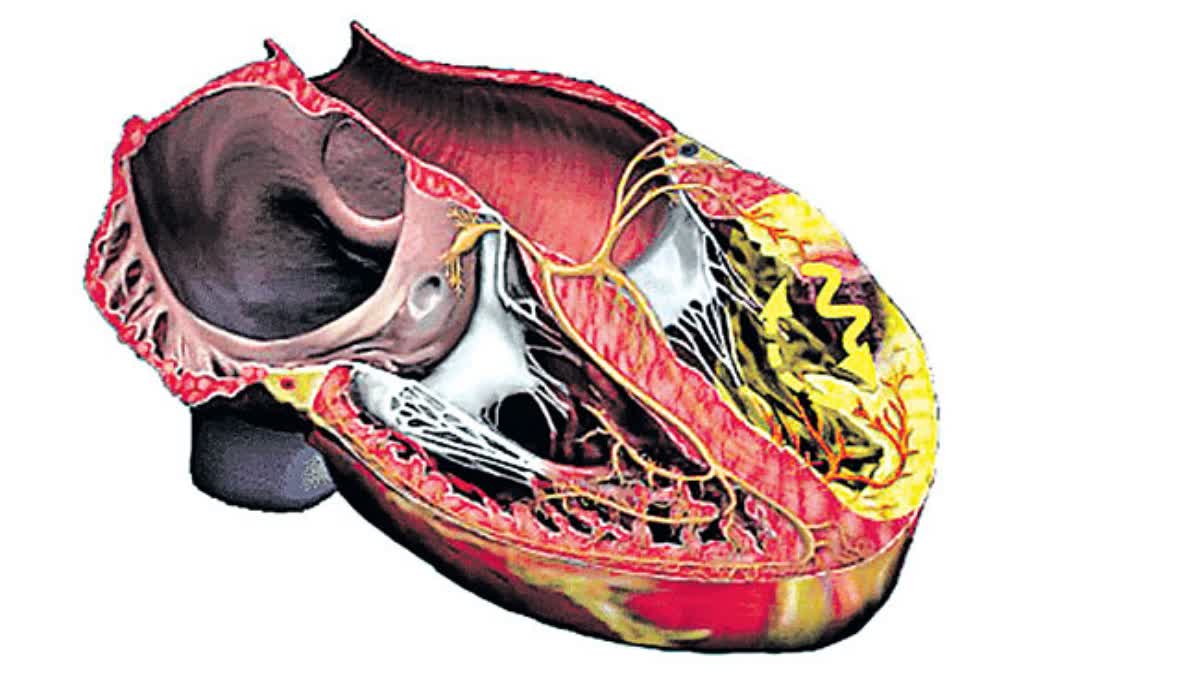 Massachusetts General Hospital  HEART REPAIR  ഹൃദയാഘാതം  ഹൃദയാഘാതം മൂലമുണ്ടാകുന്ന മരണം