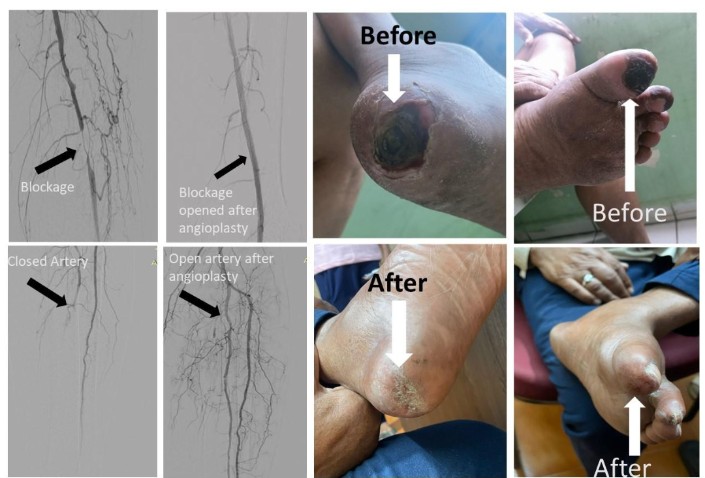 Gangreen Treatment In AIIMS Bhopal