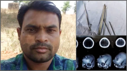 A case in Odisha's Balangir district has drawn attention after a Tantrik's unconventional treatment method of inserting needles into a young woman's head resulted in serious injuries. Authorities have intervened with legal action against the accused practitioner and arrested him.