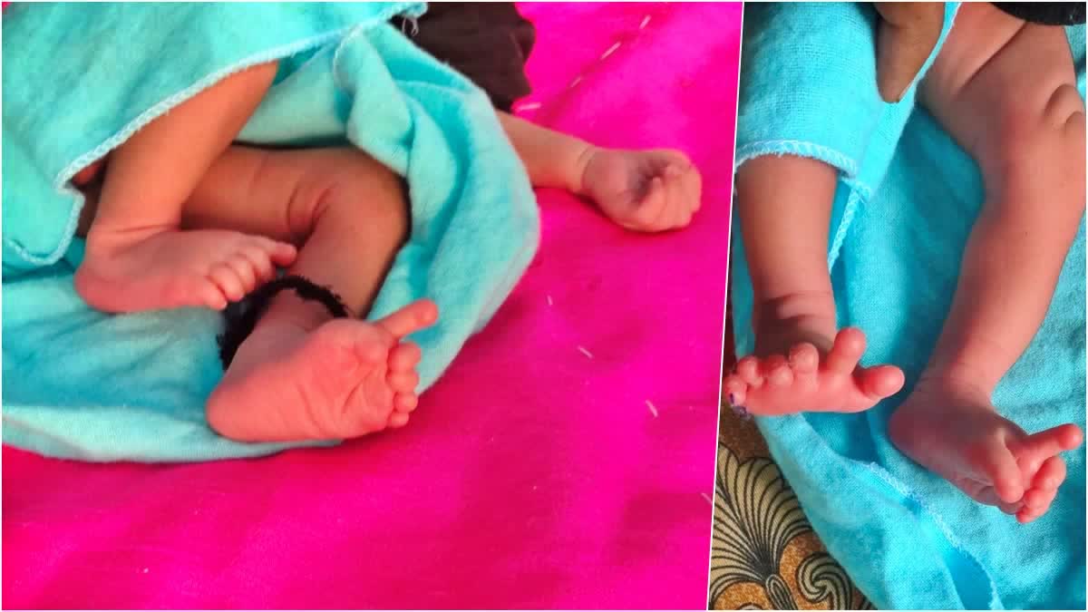 Girl born with 26 fingers  family calls her goddess  Girl born with 26 fingers in Rajasthan  ದೇವರ ಮಗುವೆಂದು ಕಂದನಿಗೆ ನಮಸ್ಕರಿಸಿದ ಜನ  ಯೋಧನಿಗೆ ಜನಸಿದ 26 ಬೆರಳುಳ್ಳ ಹೆಣ್ಣು ಮಗು  ರಾಜಸ್ಥಾನದ ಕಮಾನ್ ಆಸ್ಪತ್ರೆ  ದ್ಯಕೀಯ ಸಿಬ್ಬಂದಿ ಕೂಡ ಆಶ್ಚರ್ಯ  ಕಮಾನ್ ಬ್ರಜ್ ನಗರದ ಅತಿದೊಡ್ಡ ಸರ್ಕಾರಿ ಆಸ್ಪತ್ರೆ  ವಿಶಿಷ್ಟವಾದ ಹೆಣ್ಣು ಮಗು  ಸಿಆರ್‌ಪಿಎಫ್ ಹೆಡ್ ಕಾನ್‌ಸ್ಟೆಬಲ್ ಗೋಪಾಲ್  ನವಜಾತ ಹೆಣ್ಣು ಮಗುವಿಗೆ ಜನ್ಮ