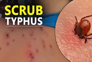 Scrub Typhus in Himachal