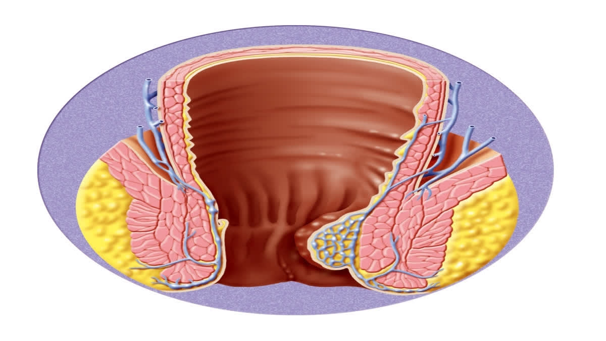 World Piles Day: Raising Awareness About Ailment Of Hemorrhoids