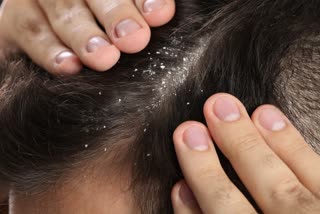 DANDRUFF HOME REMEDIES