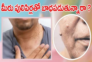 How To Rid Warts Naturally