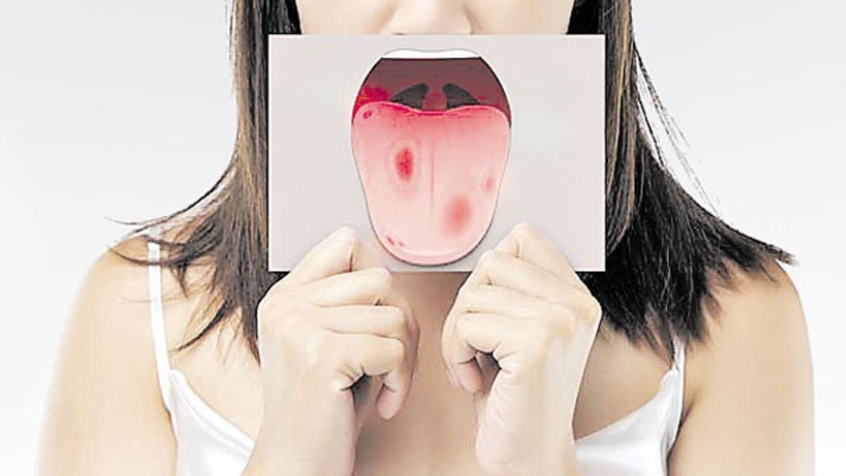 ORAL HYGIENE AND CANCER  SYMPTOMS OF ORAL CANCER  STEPS TO PREVENTING ORAL CANCER  CAUSES OF MOUTH CANCER