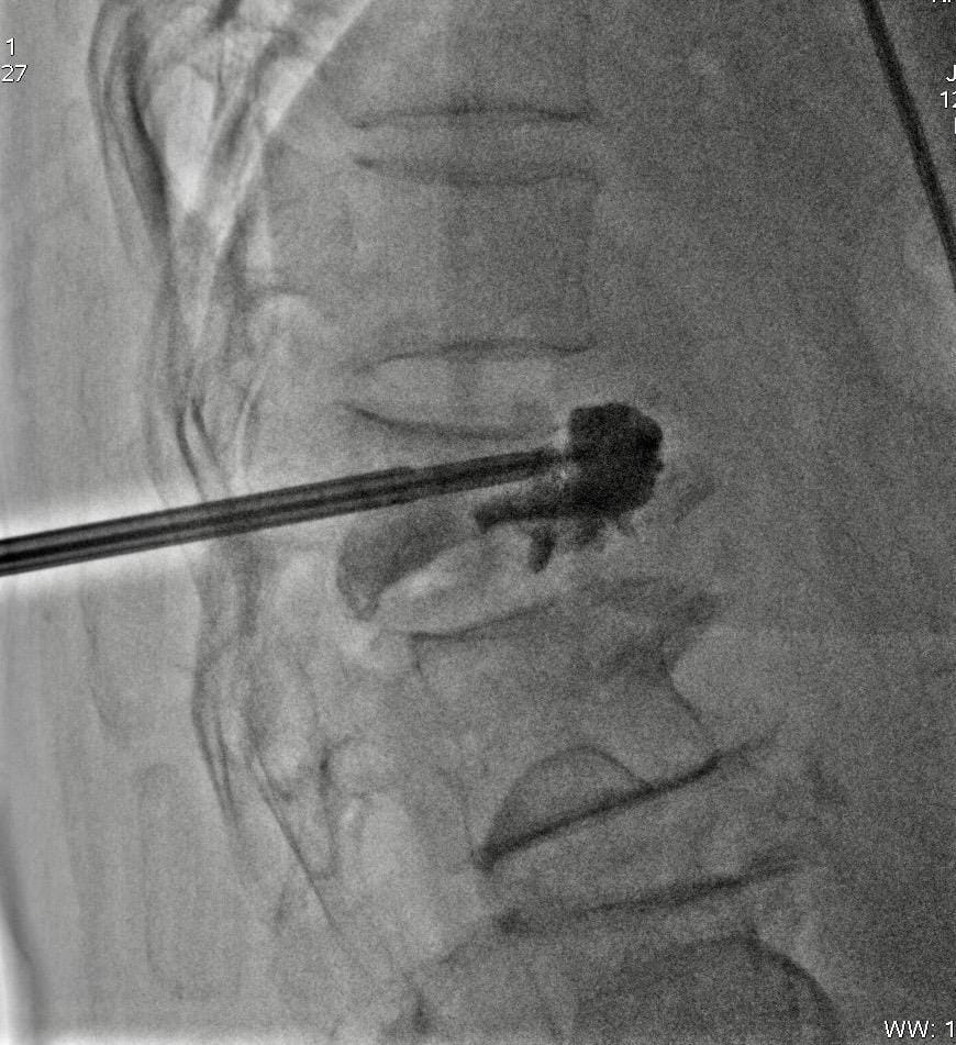 Vertebral Compression Fractures