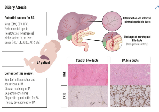 Liver at risk from birth Biliary atresia in infants Biliary atresia symptoms ಪಿತ್ತರಸದ ಅಟ್ರೆಸಿಯಾ ಕಾಯಿಲೆ