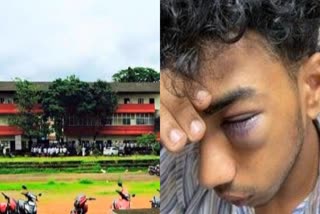 Modi  Junior student injured in ragging  Student injured in Ragging  Chathamangalam in Kozhikode  news updates in Kozhikode  latest news in Kozhikode  വസ്‌ത്ര ധാരണവും ഹെയര്‍ സ്റ്റൈലും  റാഗിങ്  ജൂനിയര്‍ വിദ്യാര്‍ഥിക്ക് ഗുരുതര പരിക്ക്  റാഗിങ്ങില്‍ ജൂനിയര്‍ വിദ്യാര്‍ഥിക്ക് പരിക്ക്  ചാത്തമംഗലം എംഇഎസ് കോളജ്  ഡിഗ്രി വിദ്യാർഥി