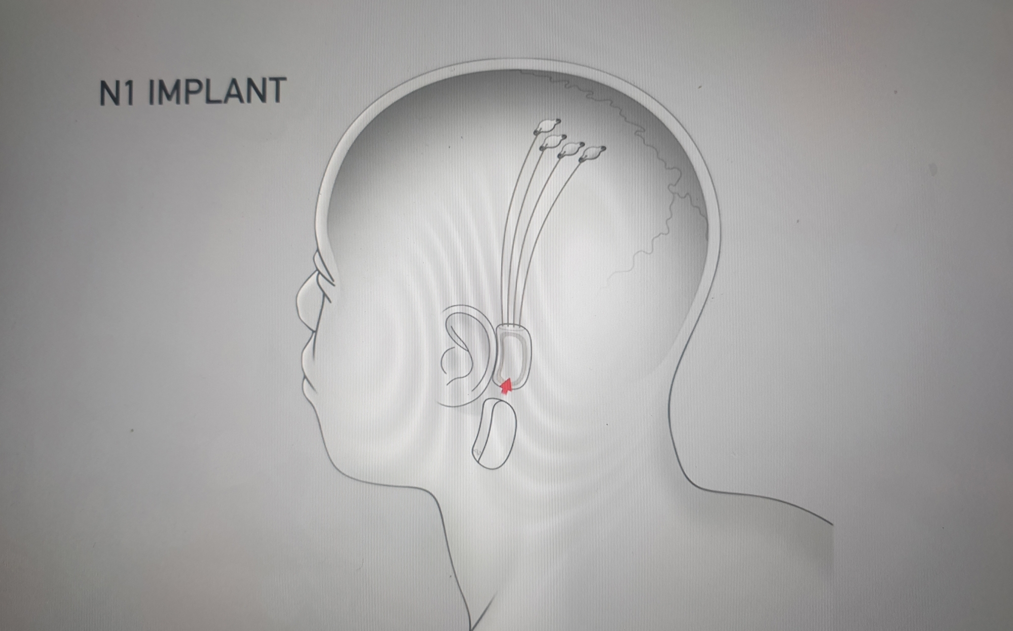 neuralink recruiting for human trial of brain computer interface