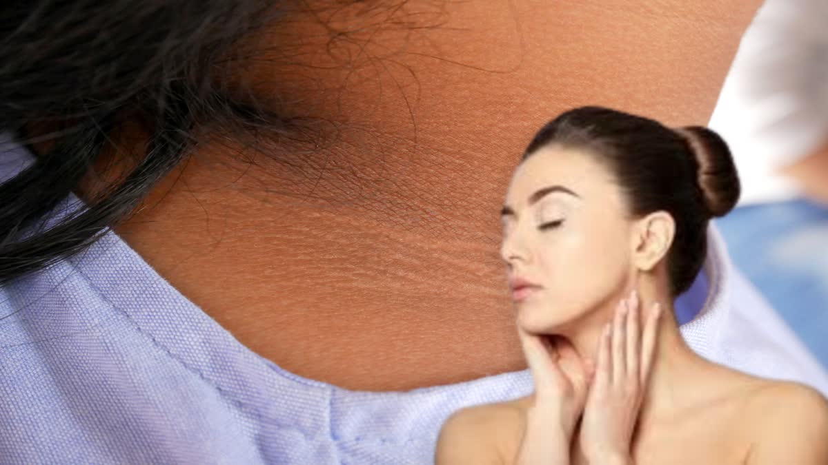 Reduce Neck Blackness News