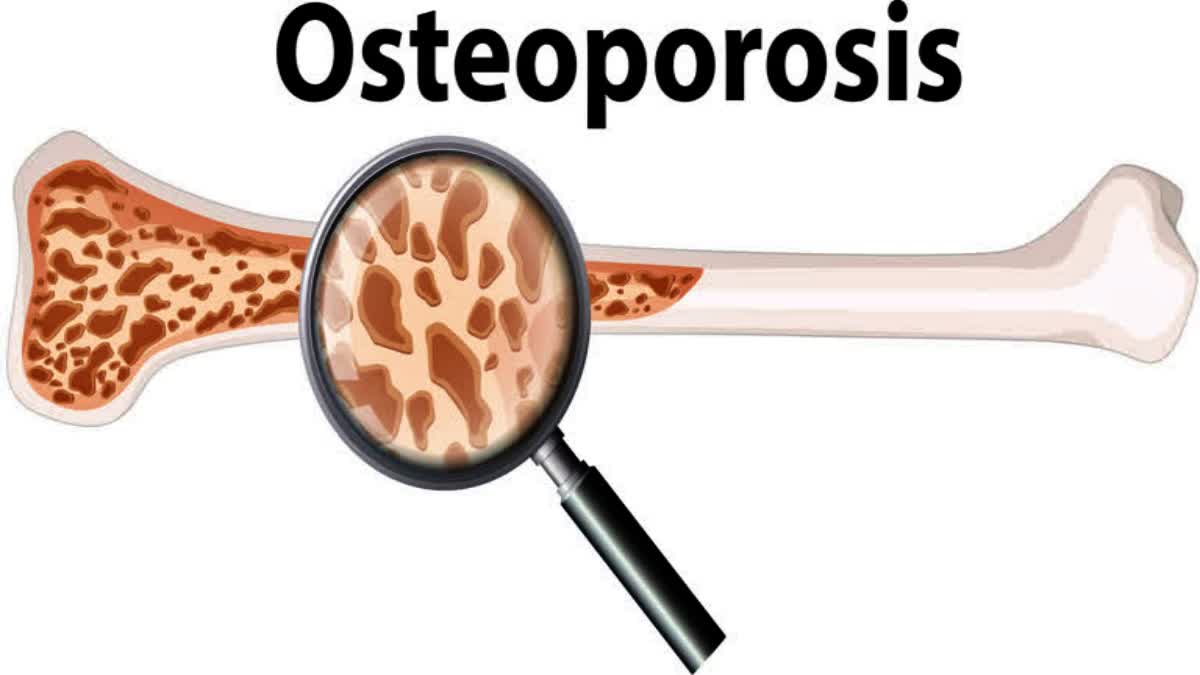World Osteoporosis Day 2023 theme Step Up for bone Health Build Better Bones .
