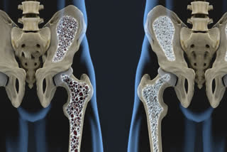 India ranks number one in Osteoporosis cases