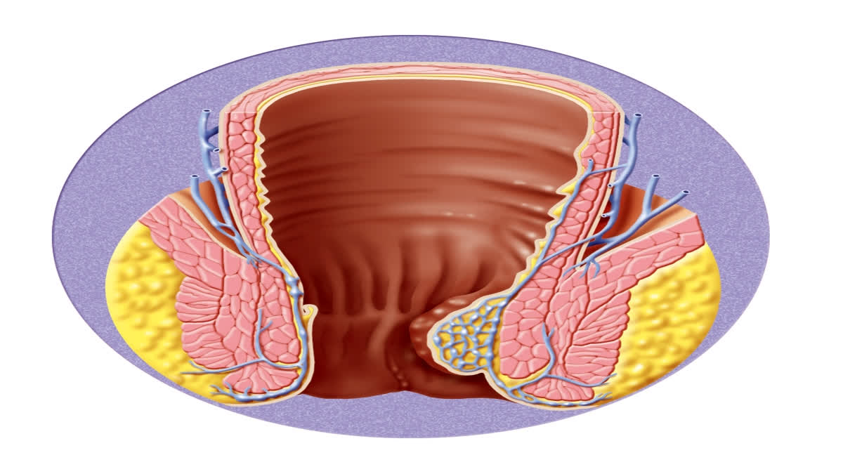 World Piles Day is observed on November 20, every year to raise awareness about hemorrhoids(piles), a collection of inflamed tissue in the anal canal.