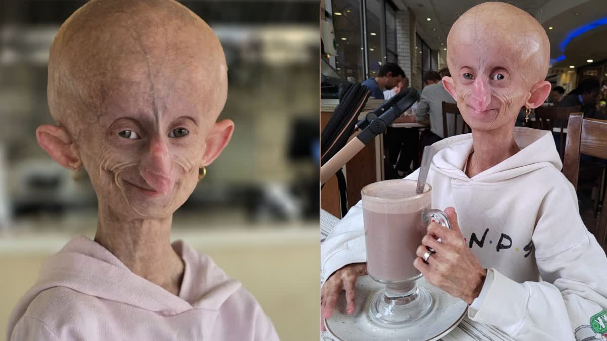 Hutchinson-Gilford Progeria Syndrome