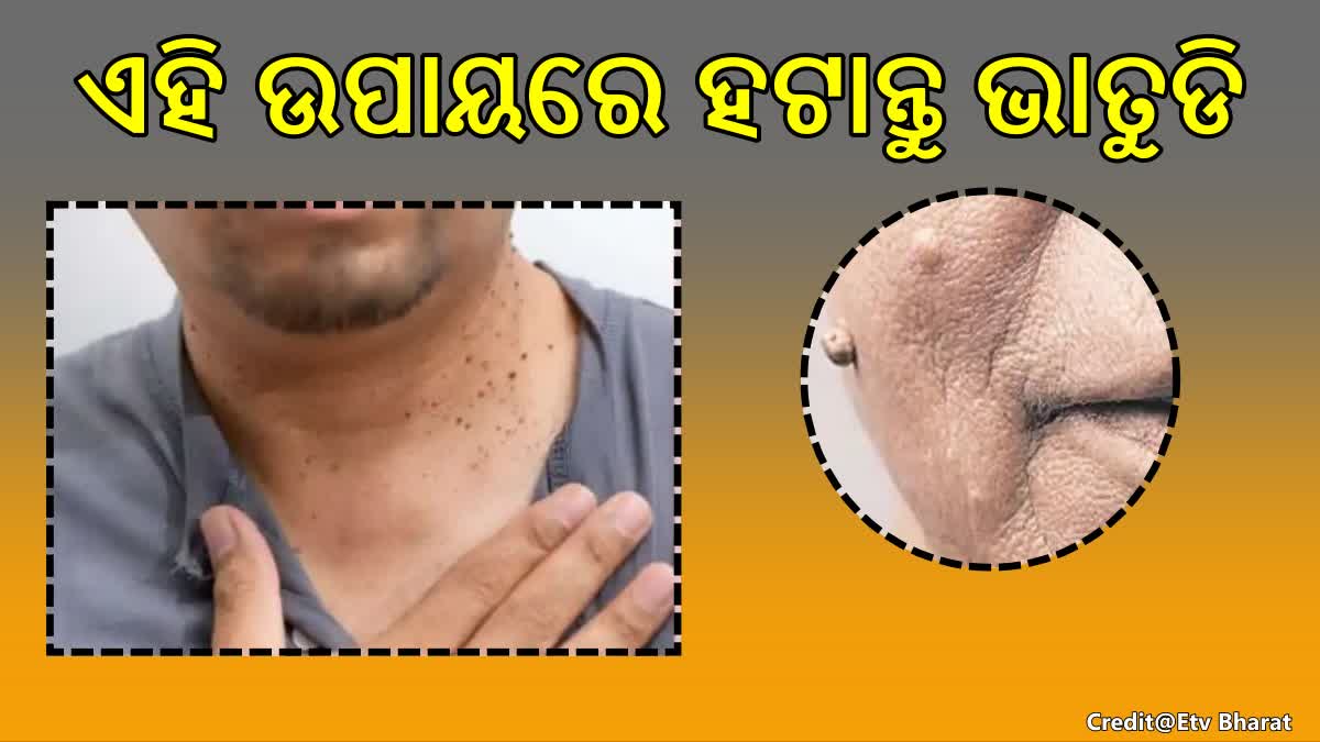 ବେକ କି ମୁହଁରେ ଭାତୁଡି ନେଇ ଚିନ୍ତିତ କି? ଏହି ଉପାୟ ଆପଣାଇ ହଟାନ୍ତୁ