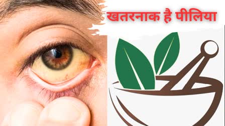 Jaundice Treatment in Ayurveda