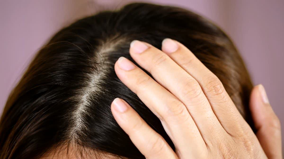 Home Remedies For Hair Scalp