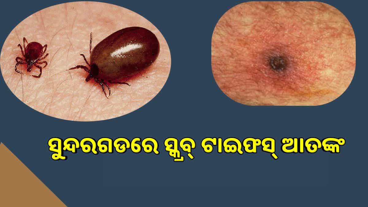 ସୁନ୍ଦରଗଡରେ 24 ଘଣ୍ଟା ମଧ୍ୟରେ 6 ସ୍କ୍ରବ ଟାଇଫସ ଚିହ୍ନଟ