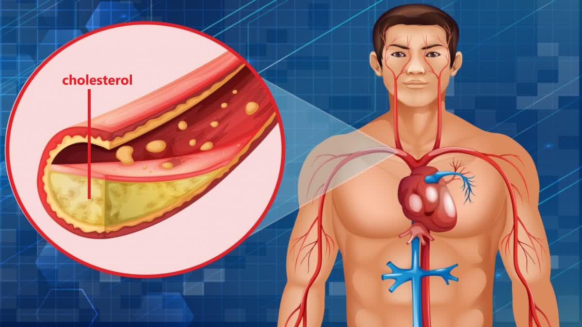 Causes  Of High Cholesterol