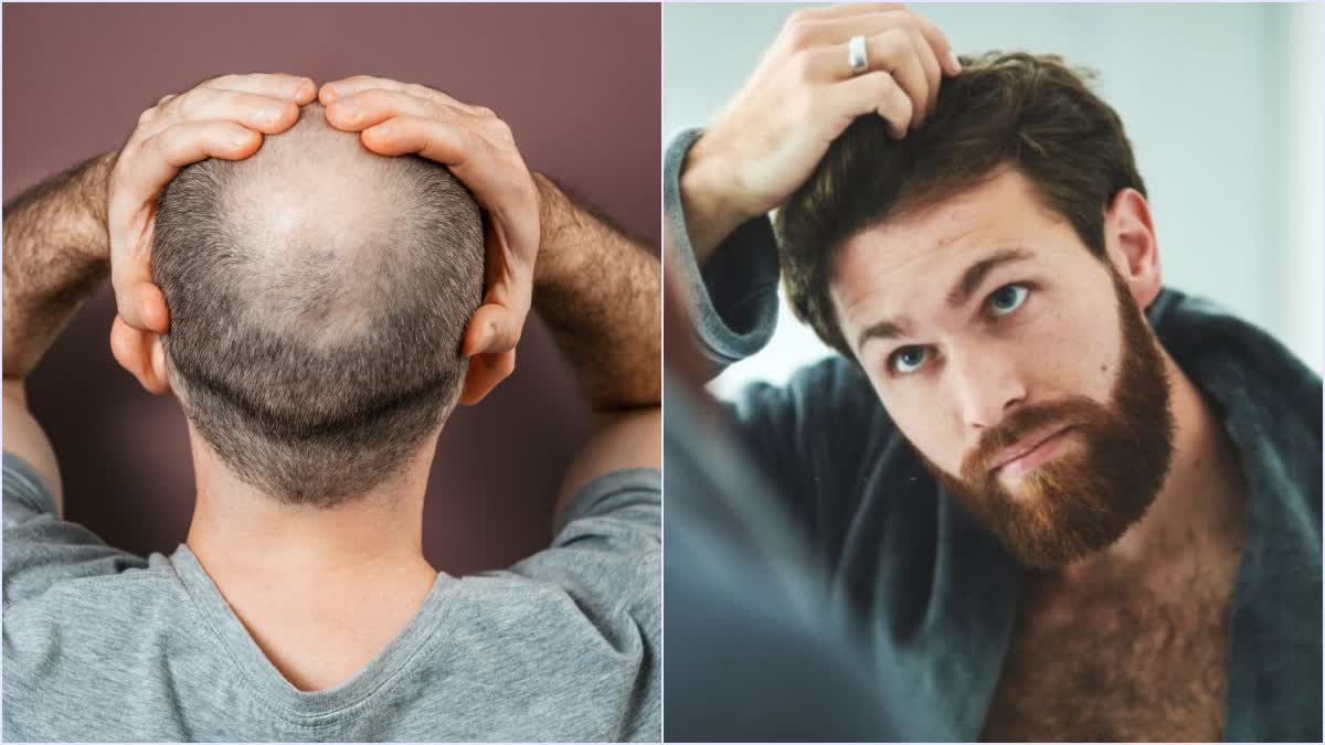 Hair Transplantation Myths and Facts