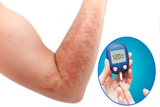 Diabetes Skin Problems