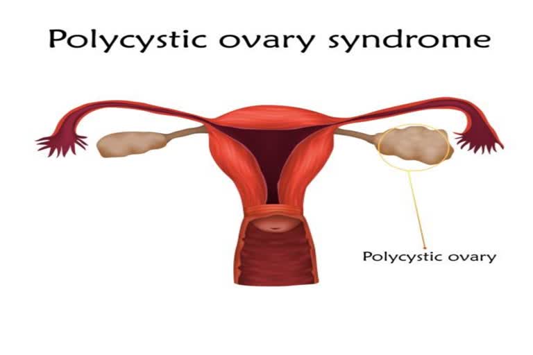 Ovarian Cancer