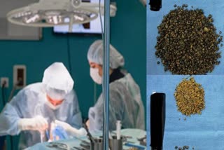 Stones In Gallbladder