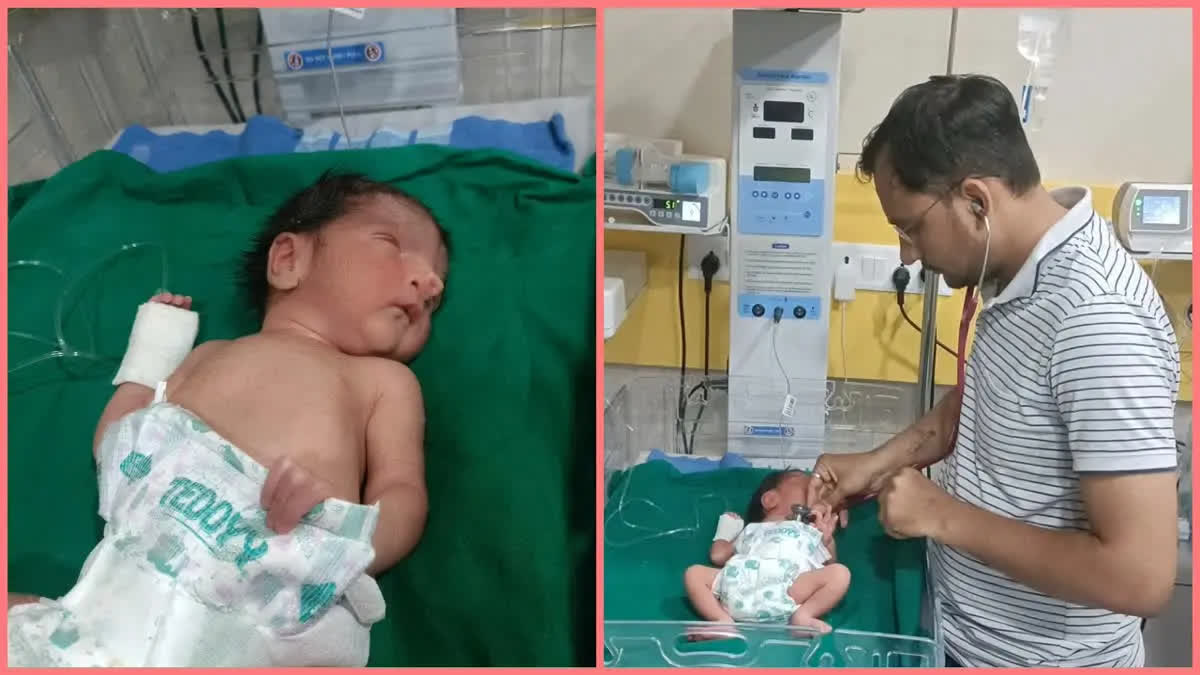 Baby Born With Two Noses