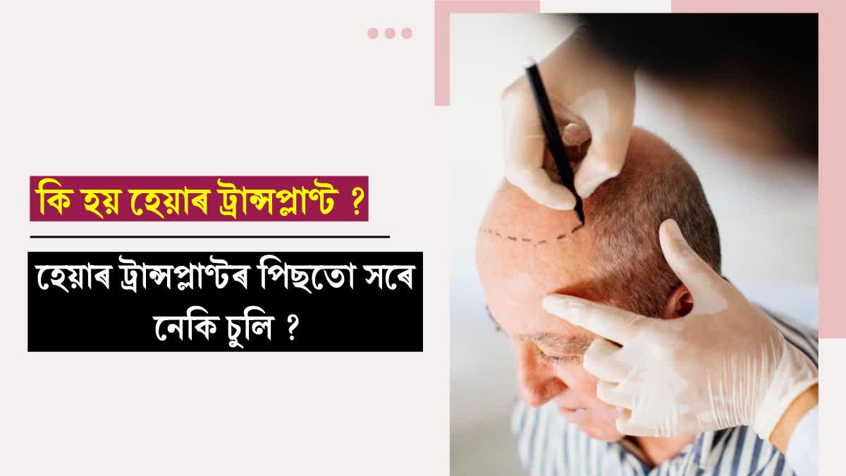 Hair Transplant: Does hair fall even after hair transplant? How safe and what to keep in mind, know from experts