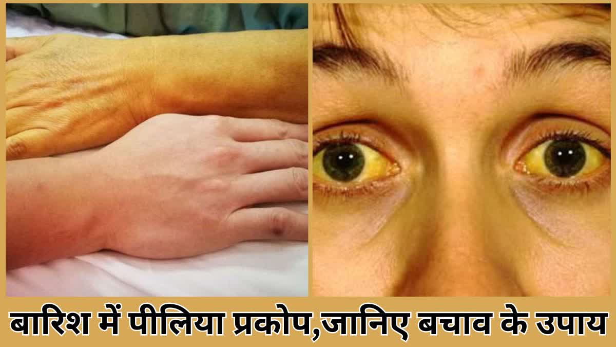 Ways to prevent jaundice