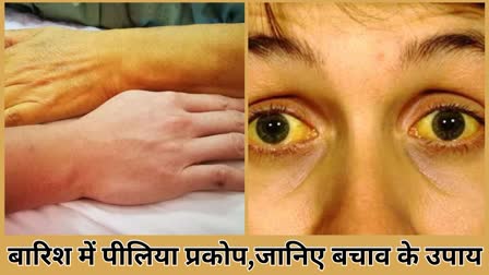 Ways to prevent jaundice