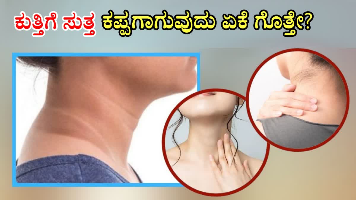 Best Home Remedies for Black Neck  HOME REMEDIES FOR BLACK NECK  HOW TO GET RID OF DARK NECK  DARK NECK WHITENING REMEDIES