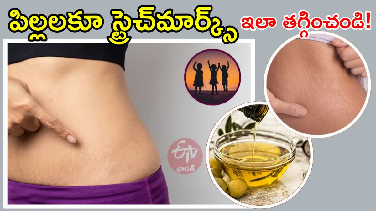 How to Reduce Stretch Marks in Children