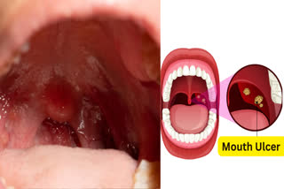 If you are troubled by mouth ulcers or muh ke chale , then applying these 4 things kept in the kitchen will give you immediate relief