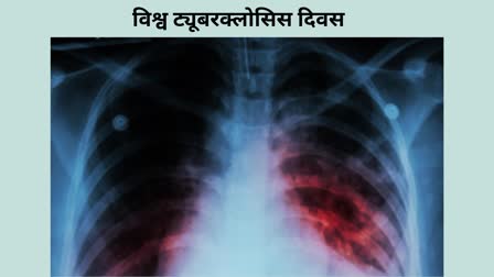 World Tuberculosis Day 2024