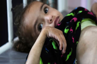Mayar Al-Arja, 2, who suffers from malnutrition, lies on a bed in a clinic in Nasser hospital, Khan Younis, Gaza on Wednesday.