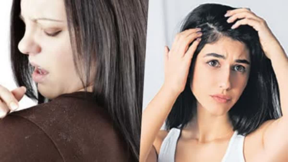 dandruff home remedies in telugu tips to prevent dandruff