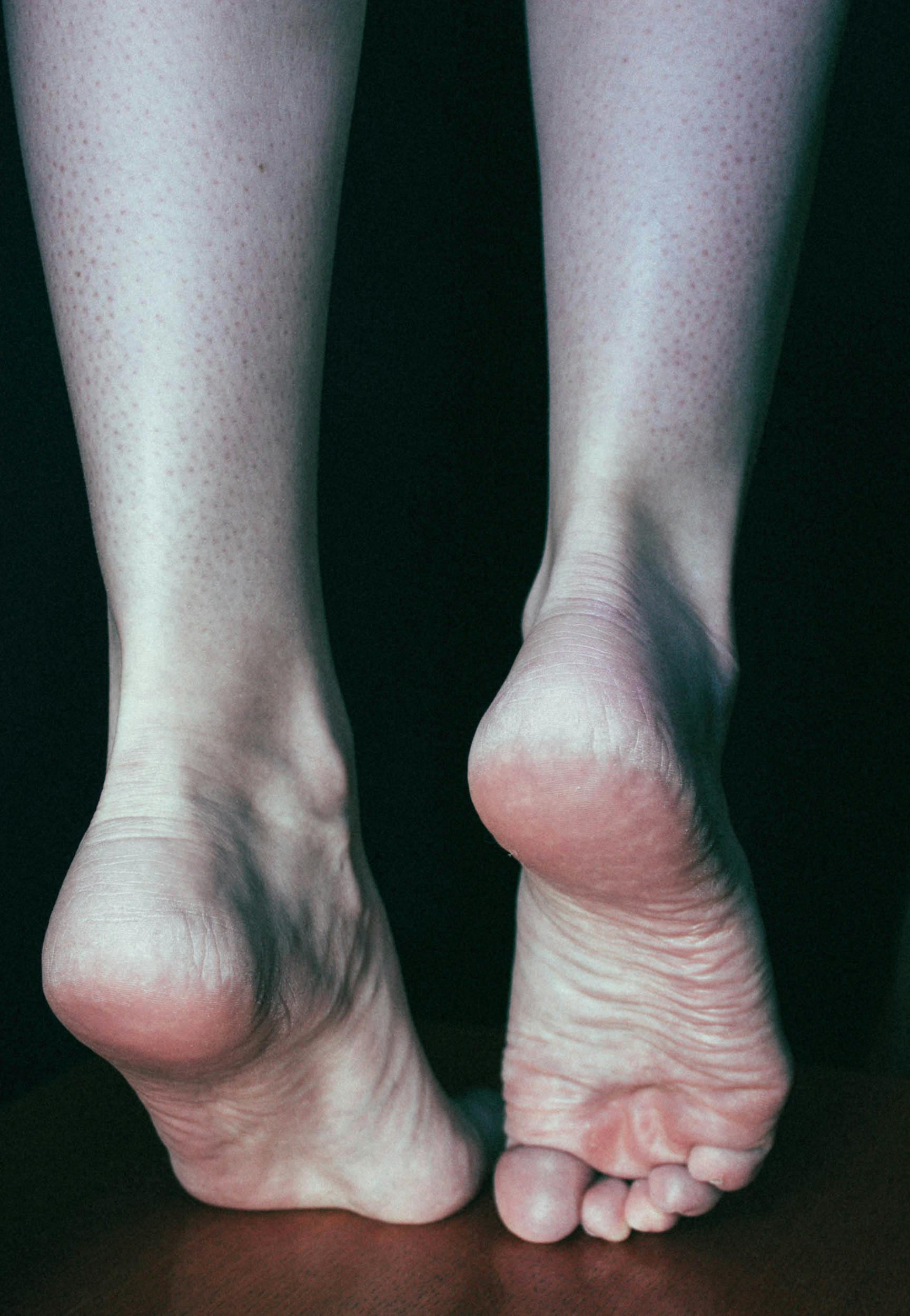 HEEL PAIN TREATMENT AND DO NOT IGNORE HEEL PAIN CAUSES