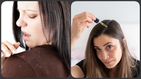 Dandruff Home Remedies