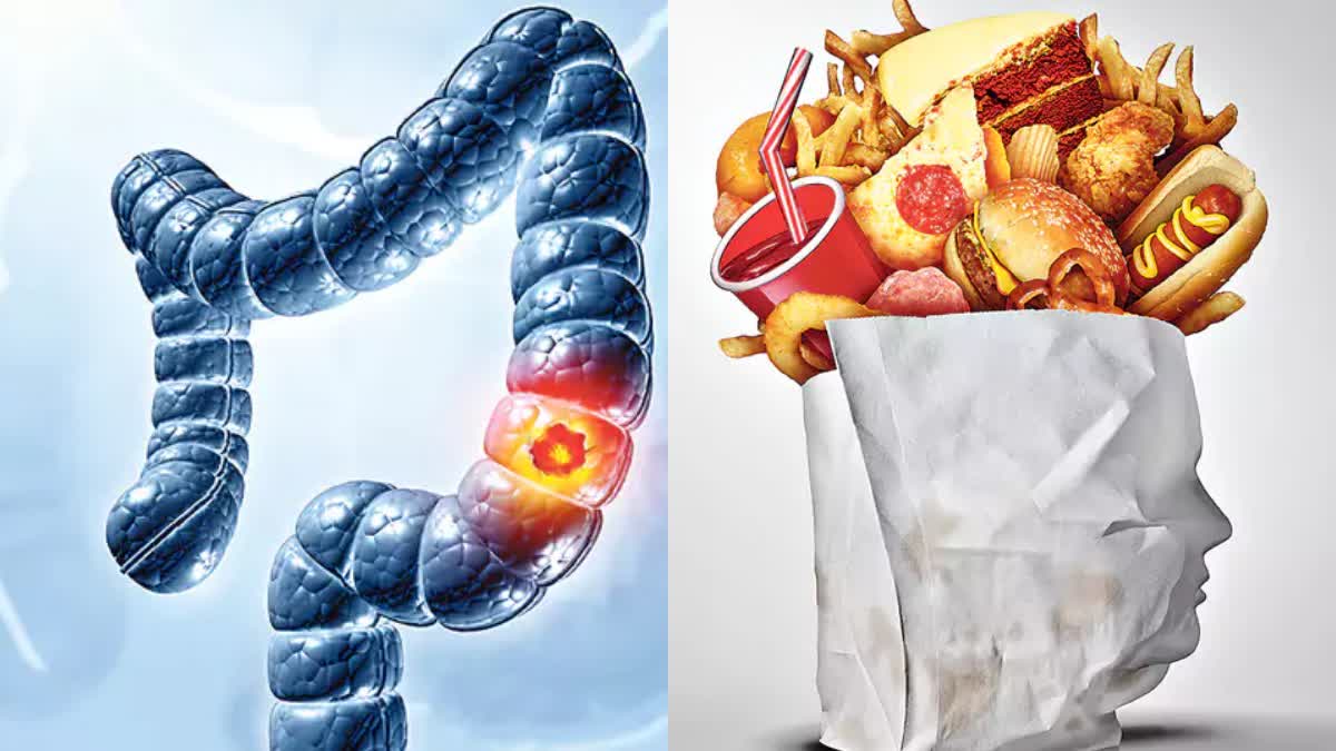 Colon Cancer Causes Food