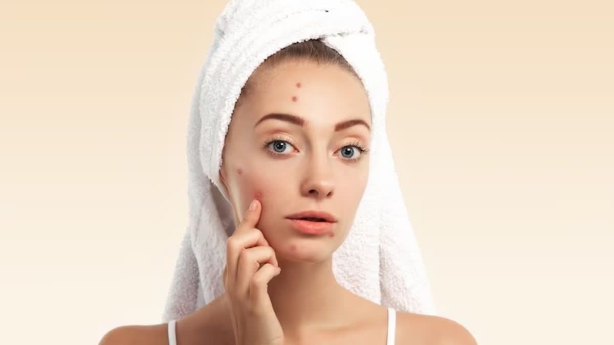 Can Pimple Breakouts Indicate Skin Cancer? Here’s What Experts Have To Say