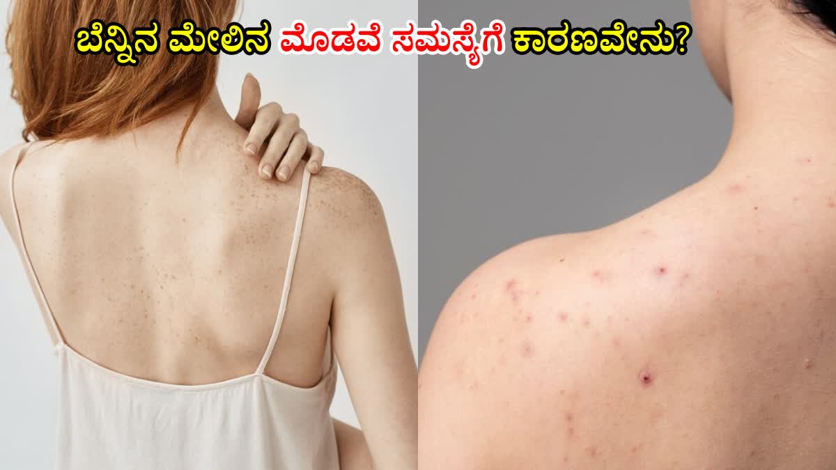 ACNE ON BACK  HOW TO REMOVE PIMPLES  HOW TO CONTROL PIMPLES ON BACK