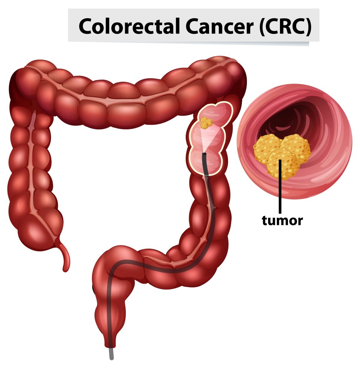 Illustration of Colorectal Cancer