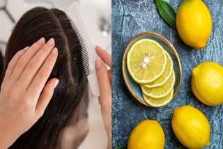 NATURAL REMEDIES TO TREAT DANDRUFF  BENEFITS OF LEMON FOR HAIR  HOW TO GET RID OF DANDRUFF  LEMON JUICE REMEDIES FOR DANDRUFF