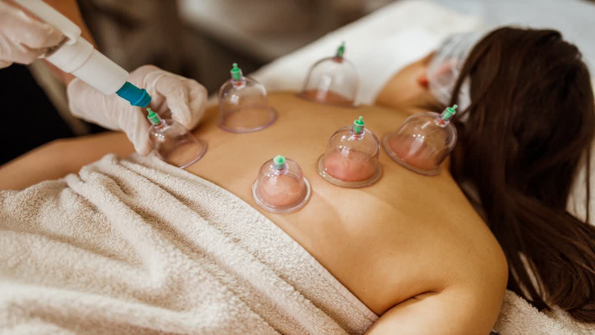 Cupping Therapy or Hijama Therapy Benefits