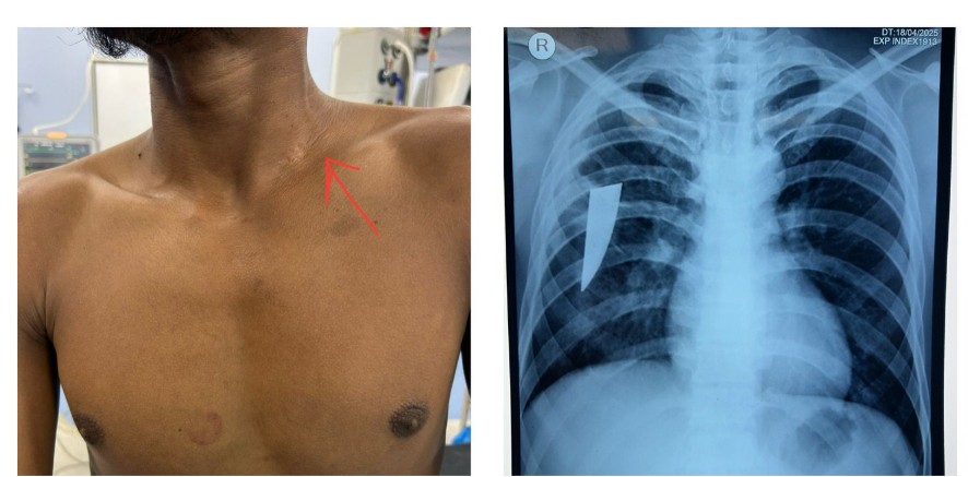 RARE SURGERY IN BRAHMAPUR MKCG