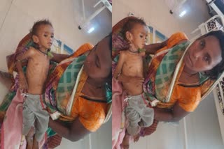 panna child suffering malnutrition