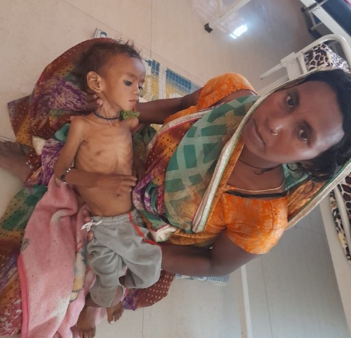 panna child suffering malnutrition