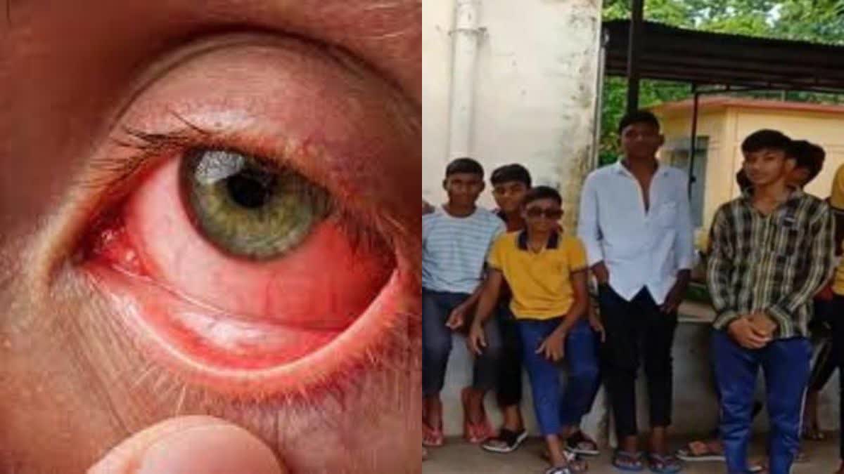 conjunctivitis infection